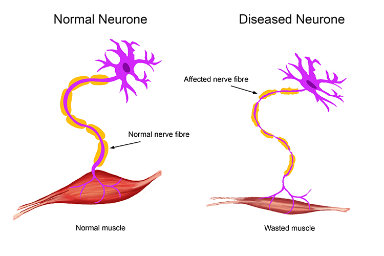 Motor neurone disease breaks down the ability to transmit signals across neurones